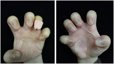 Successful treatment of nail lichen planus with tofacitinib: a case report and review of the literature